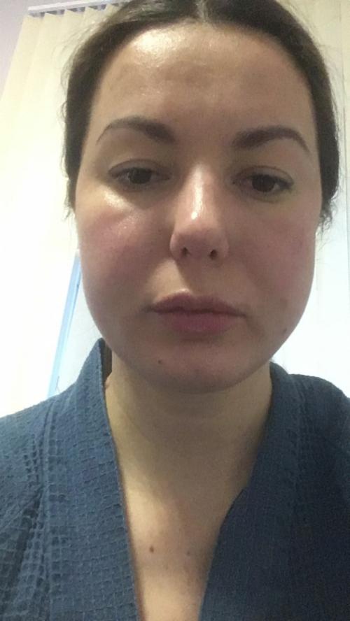 Удаление комков Биша последствия в старости. Удаление Комков Биша. мой опыт.