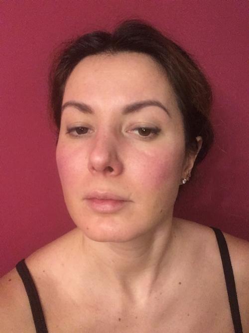 Удаление комков Биша последствия в старости. Удаление Комков Биша. мой опыт.