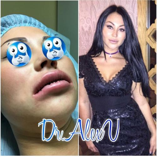 Комки Биша анджелина джоли. Что такое комки Биша и зачем их удалять 13 Комки Биша анджелина джоли. Что такое комки Биша и зачем их удалять 13