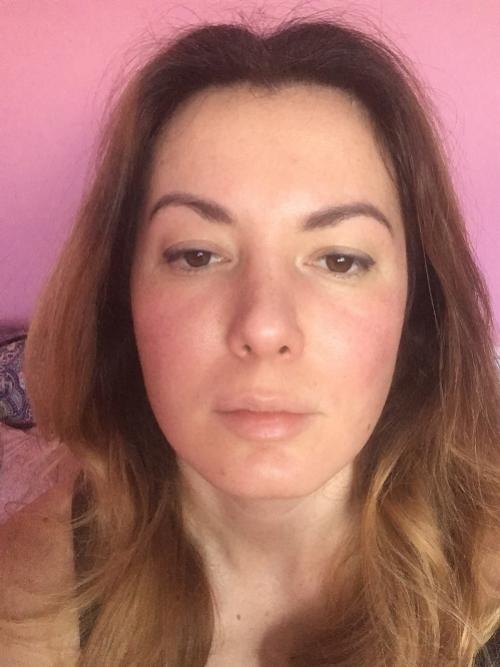 Удаление комков Биша последствия в старости. Удаление Комков Биша. мой опыт.