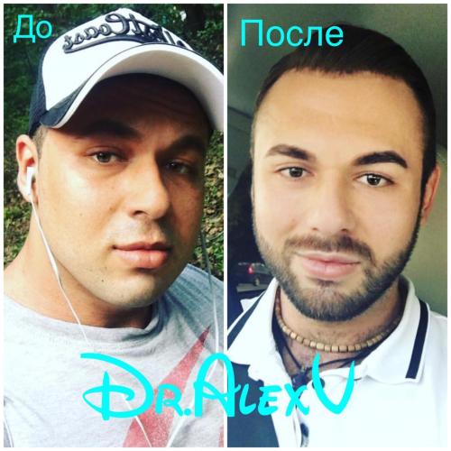 Комки Биша анджелина джоли. Что такое комки Биша и зачем их удалять 14 Комки Биша анджелина джоли. Что такое комки Биша и зачем их удалять 14