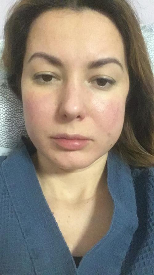 Удаление комков Биша последствия в старости. Удаление Комков Биша. мой опыт.