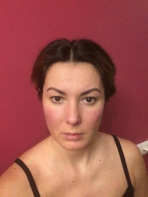 Удаление комков Биша последствия в старости. Удаление Комков Биша. мой опыт.