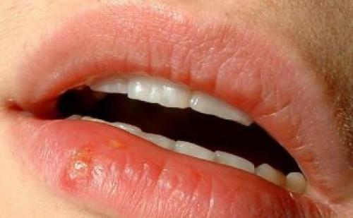 Губы сохнут и стягиваются. Почему сохнут губы