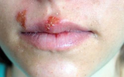 Губы сохнут и стягиваются. Почему сохнут губы