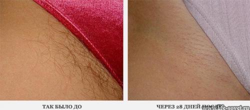 Как удалить волосы в зоне бикине. 