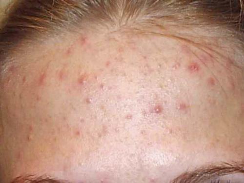 Маски для лица для жирной кожи в домашних условиях. Жирный тип — принципы ежедневного ухода 04