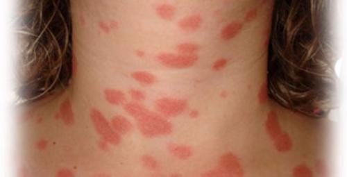 Почему после умывания лицо покрывается красными пятнами и шелушится. Почему лицо покрывается красными пятнами и шелушится?