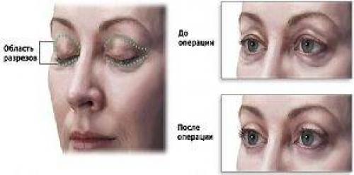 От кругов под глазами. Как убрать темные круги вокруг глаз в домашних условиях быстро, народные средства 09