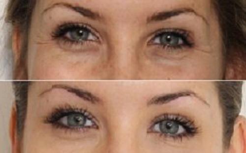 От кругов под глазами. Как убрать темные круги вокруг глаз в домашних условиях быстро, народные средства 07