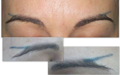 Неудачный татуаж бровей, что делать. И что теперь с этим делать?