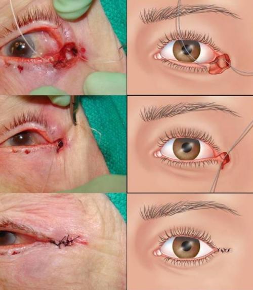 Опущенные уголки глаз операция. Кантопластика и кантопексия