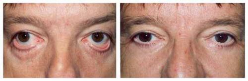 Опущенные уголки глаз операция. Кантопластика и кантопексия