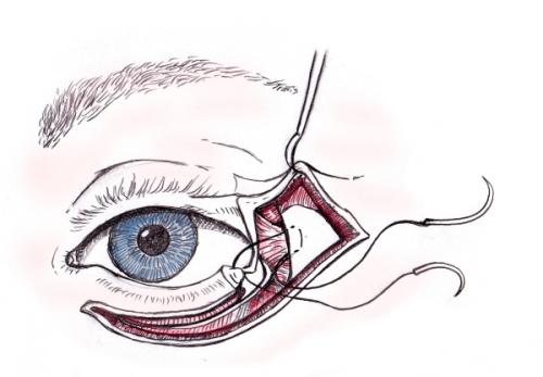 Опущенные уголки глаз операция. Кантопластика и кантопексия