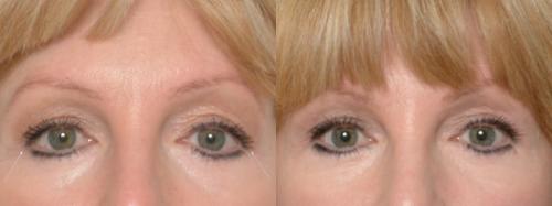 Опущенные уголки глаз операция. Кантопластика и кантопексия