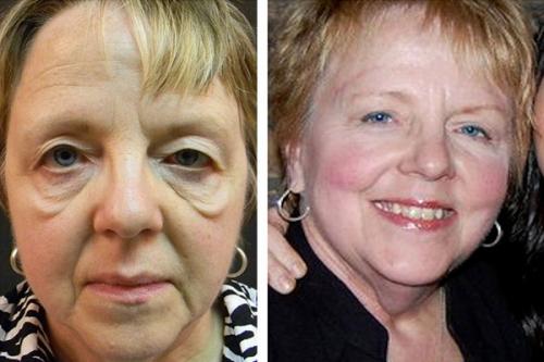 Опущенные уголки глаз операция. Кантопластика и кантопексия