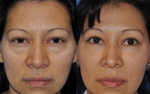 Опущенные уголки глаз операция. Кантопластика и кантопексия