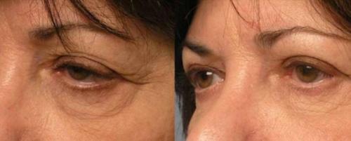 Опущенные уголки глаз операция. Кантопластика и кантопексия