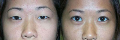 Опущенные уголки глаз операция. Кантопластика и кантопексия