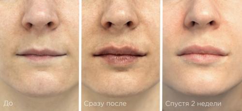 Как восстановить губы после обкусывания. Реабилитация после увеличения губ: что нельзя и что можно?