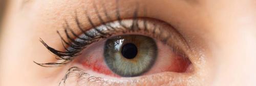 Аллергия и реакция слизистой на испарения клея. НЕПЕРЕНОСИМОСТЬ ПЛАСТМАССОВЫХ ЗУБНЫХ ПРОТЕЗОВ 03 Аллергия и реакция слизистой на испарения клея. НЕПЕРЕНОСИМОСТЬ ПЛАСТМАССОВЫХ ЗУБНЫХ ПРОТЕЗОВ 03