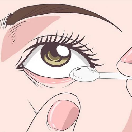 Инородное тело в глазу. Инородные тела в хрусталике 03 Инородное тело в глазу. Инородные тела в хрусталике 03