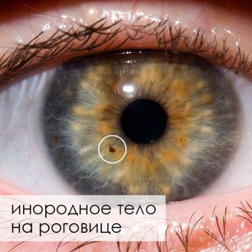 Соринка попала в глаз. Советы врача: Что делать, если в глаз попал инородный предмет? 03 Соринка попала в глаз. Советы врача: Что делать, если в глаз попал инородный предмет? 03