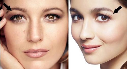 Что такое нависающее веко. Эндоскопическая подтяжка бровей или верхней трети лица 06 Что такое нависающее веко. Эндоскопическая подтяжка бровей или верхней трети лица 06