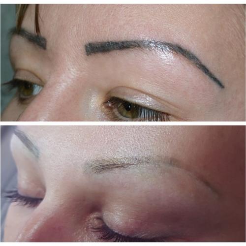 Способы удаления перманентного макияжа. Лазер – основное средство для удаления перманентного макияжа 08 Способы удаления перманентного макияжа. Лазер – основное средство для удаления перманентного макияжа 08