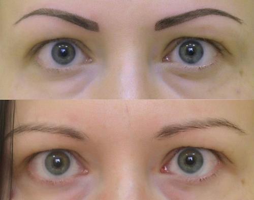 Как и чем удалить татуировку. Удаление тату: как быстро и безопасно избавиться от надоевшей татуировки 01 Как и чем удалить татуировку. Удаление тату: как быстро и безопасно избавиться от надоевшей татуировки 01