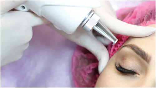 Лазерная коррекция татуажа бровей. Современные и безопасные способы удаления пигмента 01 Лазерная коррекция татуажа бровей. Современные и безопасные способы удаления пигмента 01