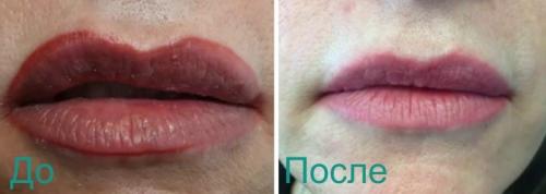 Как ведут себя брови после удаления лазером. Лазерное удаление перманентного макияжа