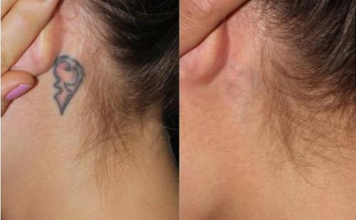 Особенности лазерного удаления татуировок и татуажа. Как лазеры дробят пигмент 02 Особенности лазерного удаления татуировок и татуажа. Как лазеры дробят пигмент 02