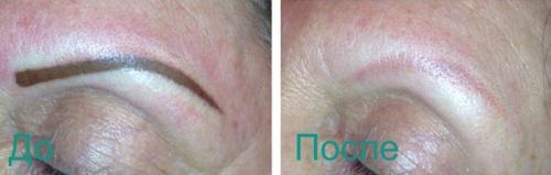 После лазерного удаления татуажа бровей. Лазерное удаление перманентного макияжа