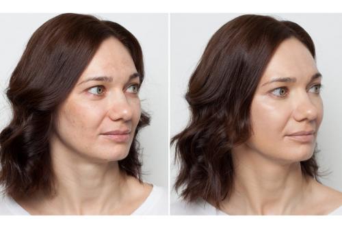 МАКИЯЖ для проблемной кожи. 10 правил макияжа при акне 07 МАКИЯЖ для проблемной кожи. 10 правил макияжа при акне 07