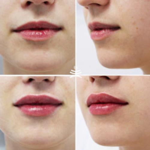 Пухлые губы. Бантик, ангел или купидон? Основные техники увеличения губ