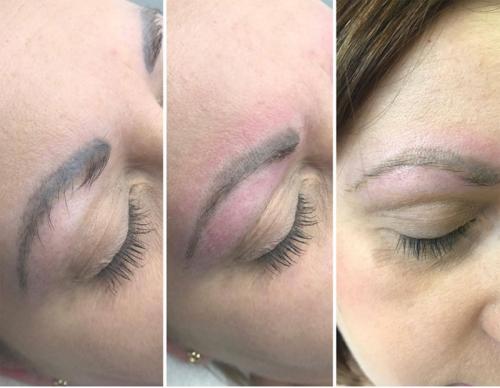 Удаление татуажа губ лазером. Показания и противопоказания 07