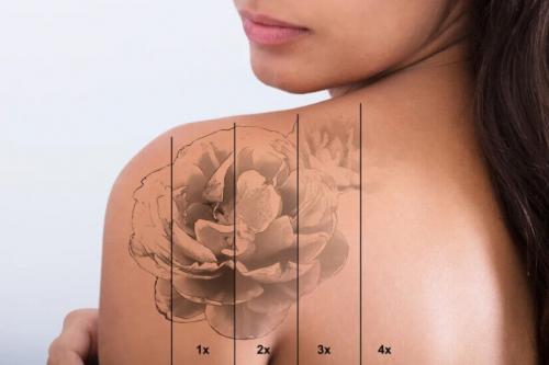 Лучшие лазеры для удаления перманентного макияжа. Принцип работы неодимового лазера