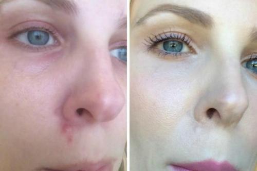 Как замаскировать прыщи на лице в домашних условиях. Способы замаскировать прыщи 05