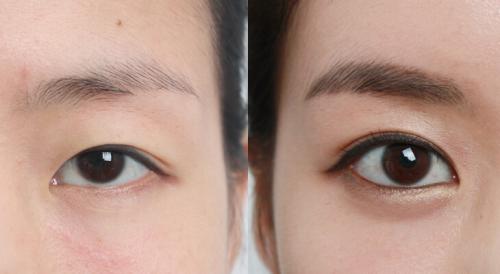 Форму глаз, как изменить. Кантопластика: виды и результат 05 Форму глаз, как изменить. Кантопластика: виды и результат 05