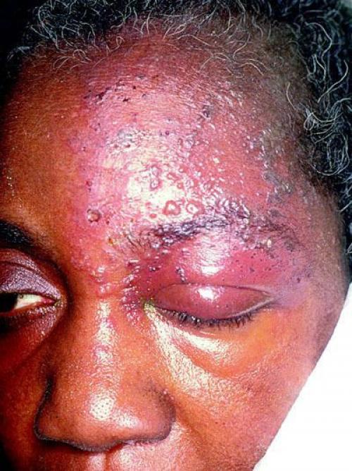 Воспаление тройничного лицевого нерва. Симптомы невралгии тройничного нерва 01