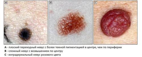 8 главных вопросов о родинках. 11 вопросов о родинках 01