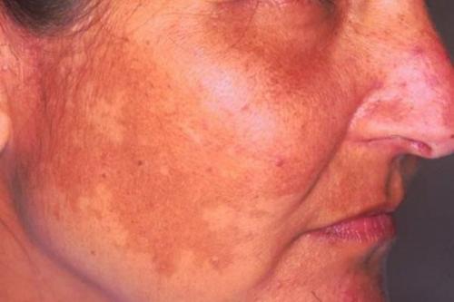 Как избавиться от пигментных пятен. Симптомы гиперпигментации кожи 01 Как избавиться от пигментных пятен. Симптомы гиперпигментации кожи 01