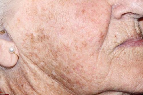 Как избавиться от пигментных пятен. Симптомы гиперпигментации кожи 05 Как избавиться от пигментных пятен. Симптомы гиперпигментации кожи 05