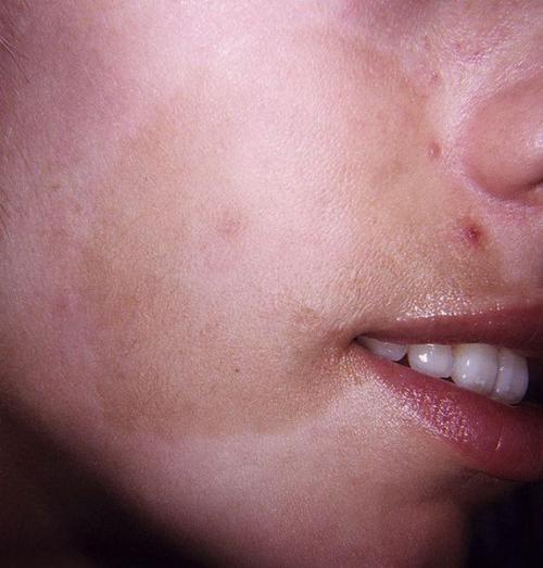 Как избавиться от пигментных пятен. Симптомы гиперпигментации кожи 06 Как избавиться от пигментных пятен. Симптомы гиперпигментации кожи 06