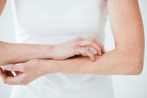 Как избавиться от пигментных пятен. Симптомы гиперпигментации кожи 08