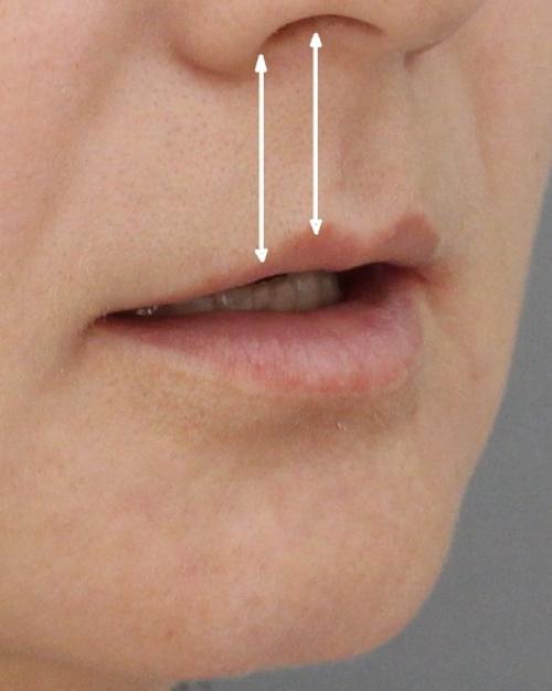 Обезболивание при увеличении губ. Подготовка к увеличению губ 01