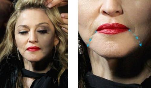 Отзыв о Увеличение губ гиалуроновой кислотой. Как увеличить губы, чтобы получить Red Carpet look? 06