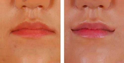 Отзыв о Увеличение губ гиалуроновой кислотой. Как увеличить губы, чтобы получить Red Carpet look? 05