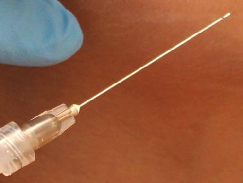 Отзыв о Увеличение губ гиалуроновой кислотой. Как увеличить губы, чтобы получить Red Carpet look? 07